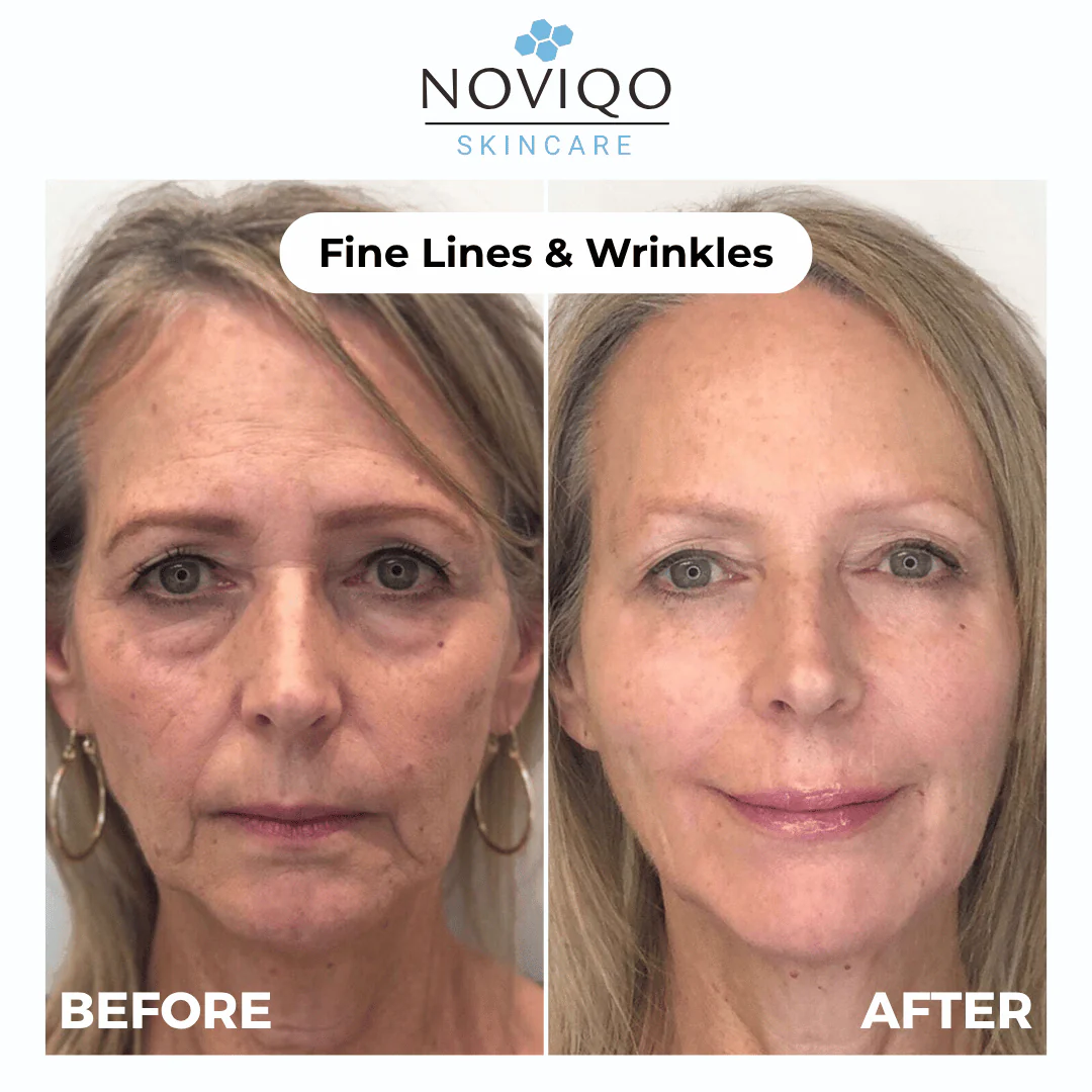 Noviqo™ – Anti-Wrinkle Freeze-Dried Nano-Silk Collagen System