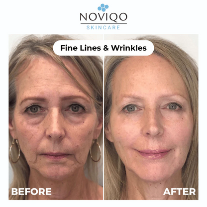 Noviqo™ – Anti-Wrinkle Freeze-Dried Nano-Silk Collagen System