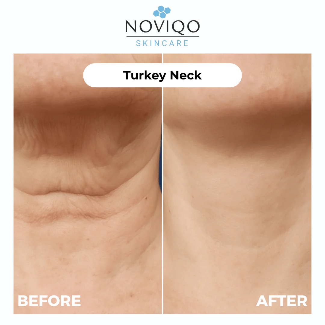 Noviqo™ – Anti-Wrinkle Freeze-Dried Nano-Silk Collagen System
