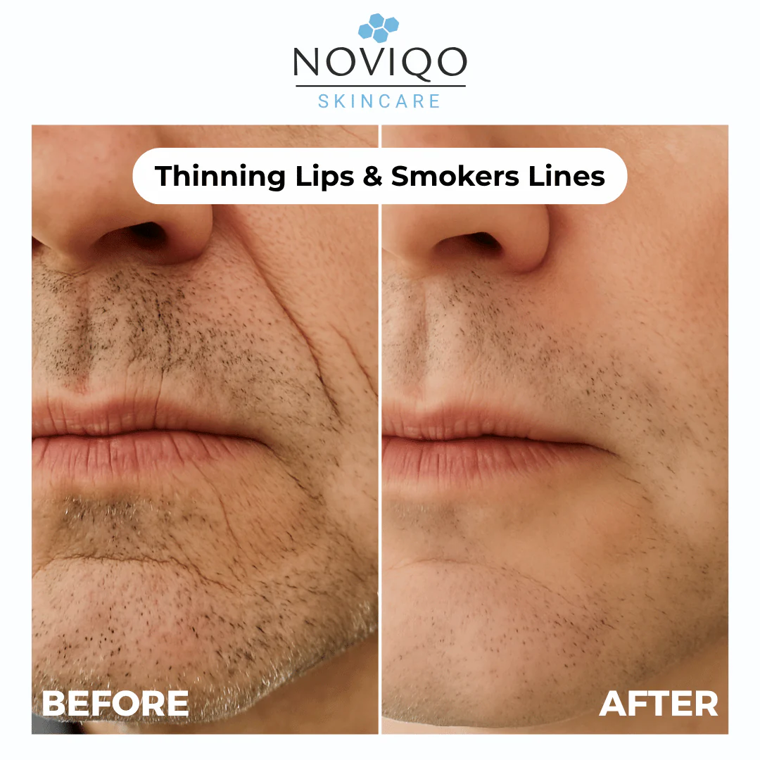 Noviqo™ – Anti-Wrinkle Freeze-Dried Nano-Silk Collagen System